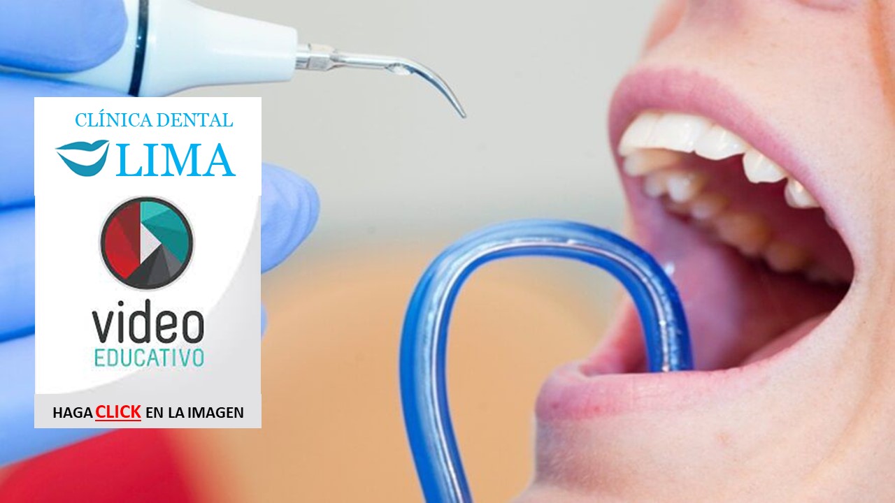 Limpieza Dental con Ultrasonido en Lima