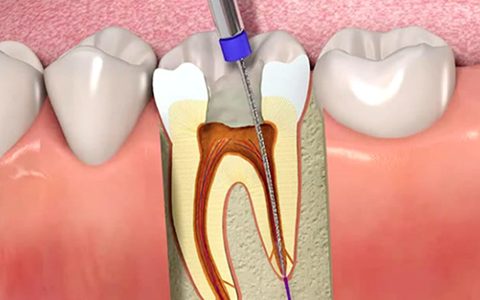 Endodoncia Clínica LIMA