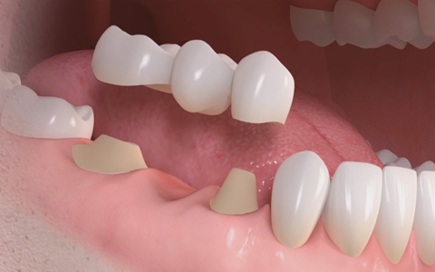 Prótesis Dental